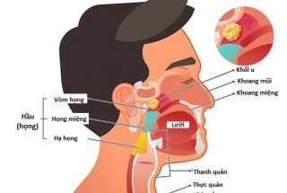 TÌM HIỂU VỀ UNG THƯ VÒM HỌNG